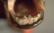 Photo displaying the teeth of the Colossoma nigripinnis
